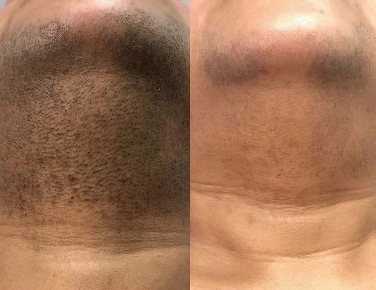 Мужской и женский шугаринг, лазерная эпиляция