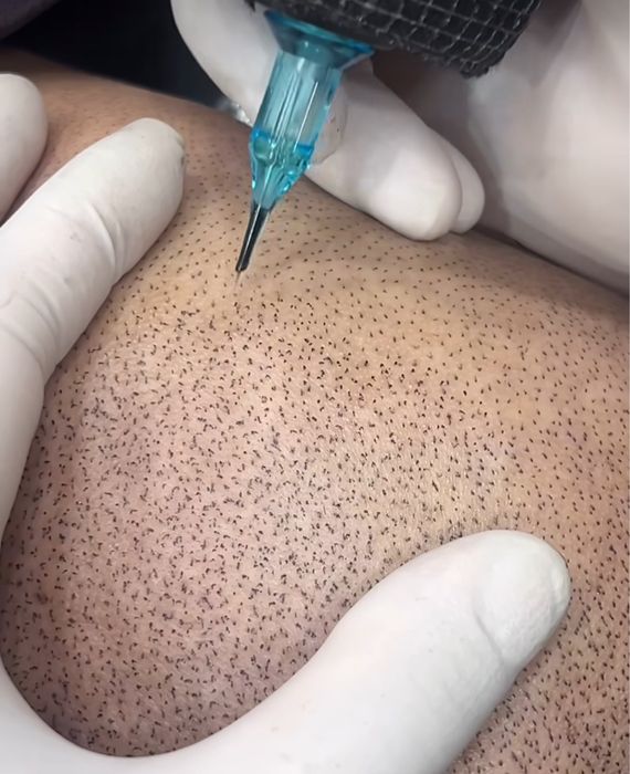 Micropigmentare Scalp și barba Bucuresti SMP chelie implant transplant