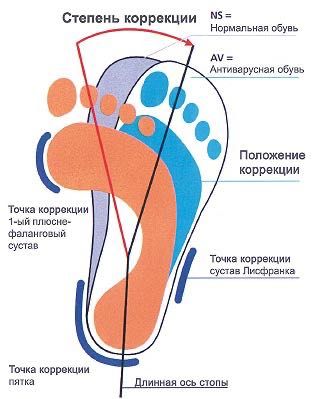 Антиварусная ортопедическая обувь с отведенным открытым носком. Вальгу