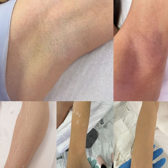 Epilare definitiva cu laser Dioda