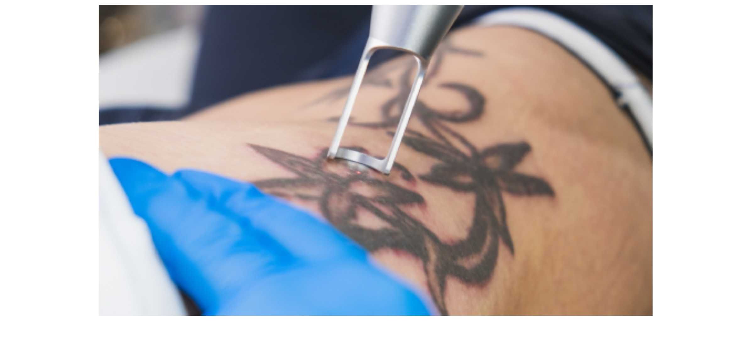 Stergere / scoatere tatuaje