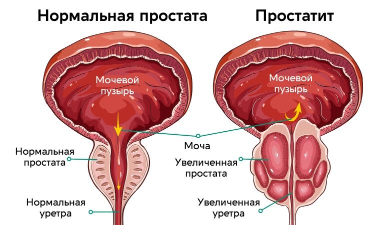 Урологический массаж