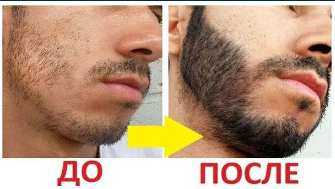 Миноксидил 5% .Minoxidil. Средство для роста бороды и волос