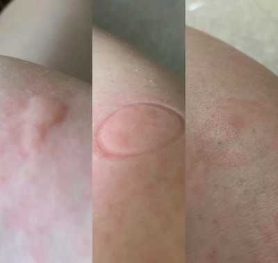 Bug Bite Thing - за след ухапване от комари, спира подуване и сърбеж