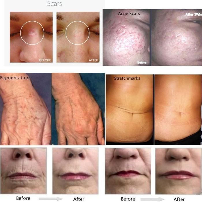 Dermaroller 0.25 mm si 2 mm