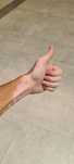 Vitiligo tratament