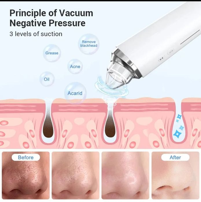 Aparat pentru Îndepărtarea Punctelor Negre și Impurităților ,Camera HD