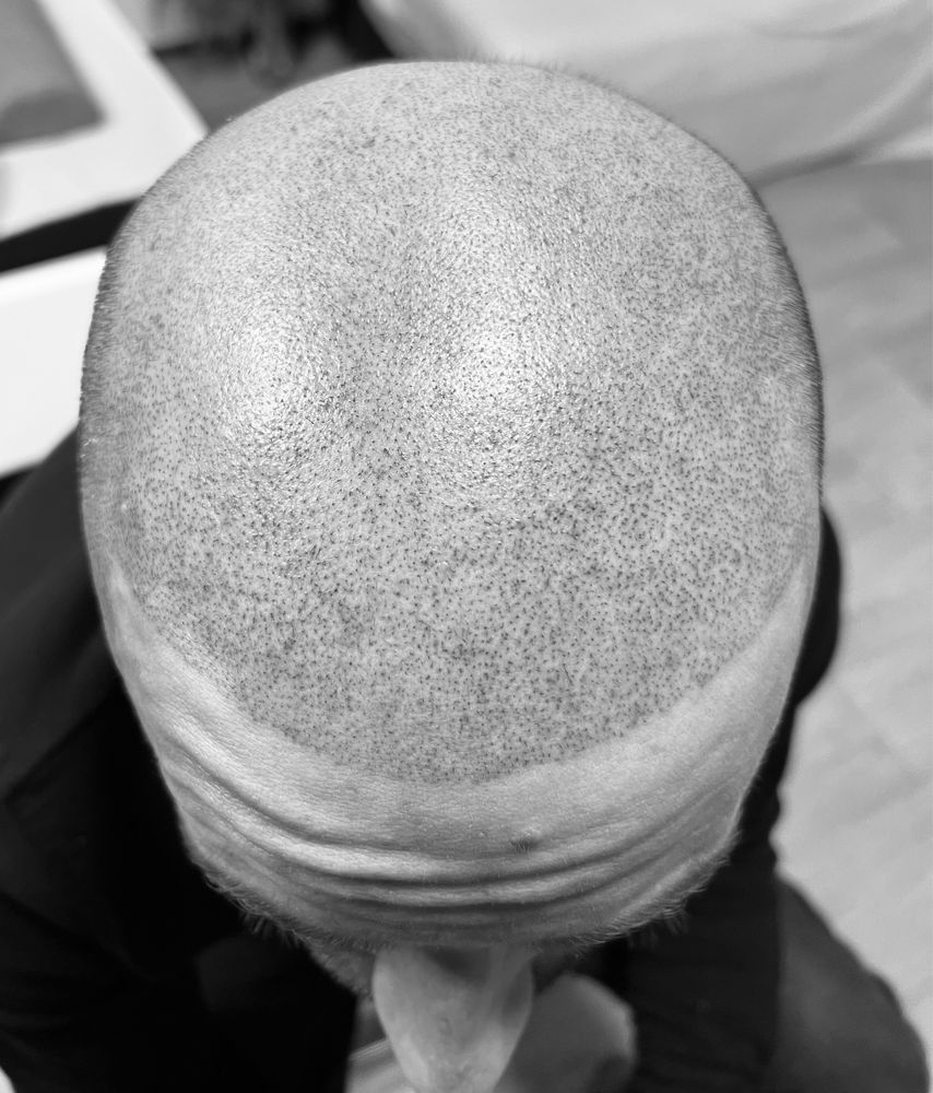 Micropigmentare scalp tricopigmentare efect indesire par alopecie