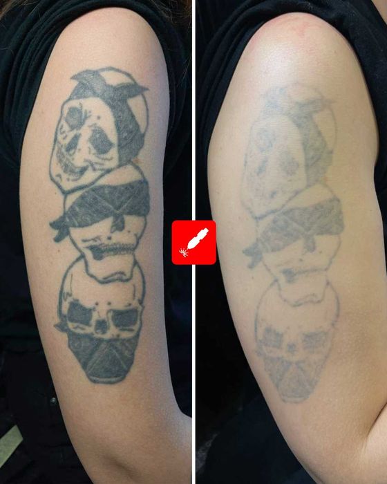 Лазерно Премахване на Татуировки