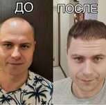 Протезирование волосы для мужчины и женщины