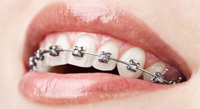 Aparat dentar ortodontic