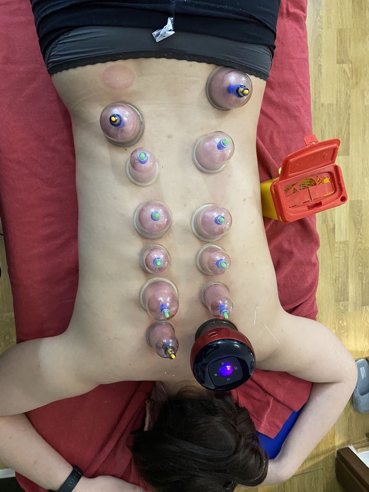 Recuperare Neurologică, Chiropractica,Acupunctură, Cupping( Ventuze)