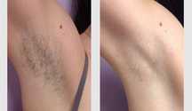Epilare cu laser definitiva rezultate garantate
