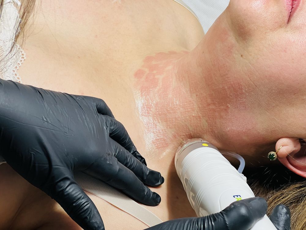 Echipament radiofrecventa fractionata Explore cu 40 de capete incluse
