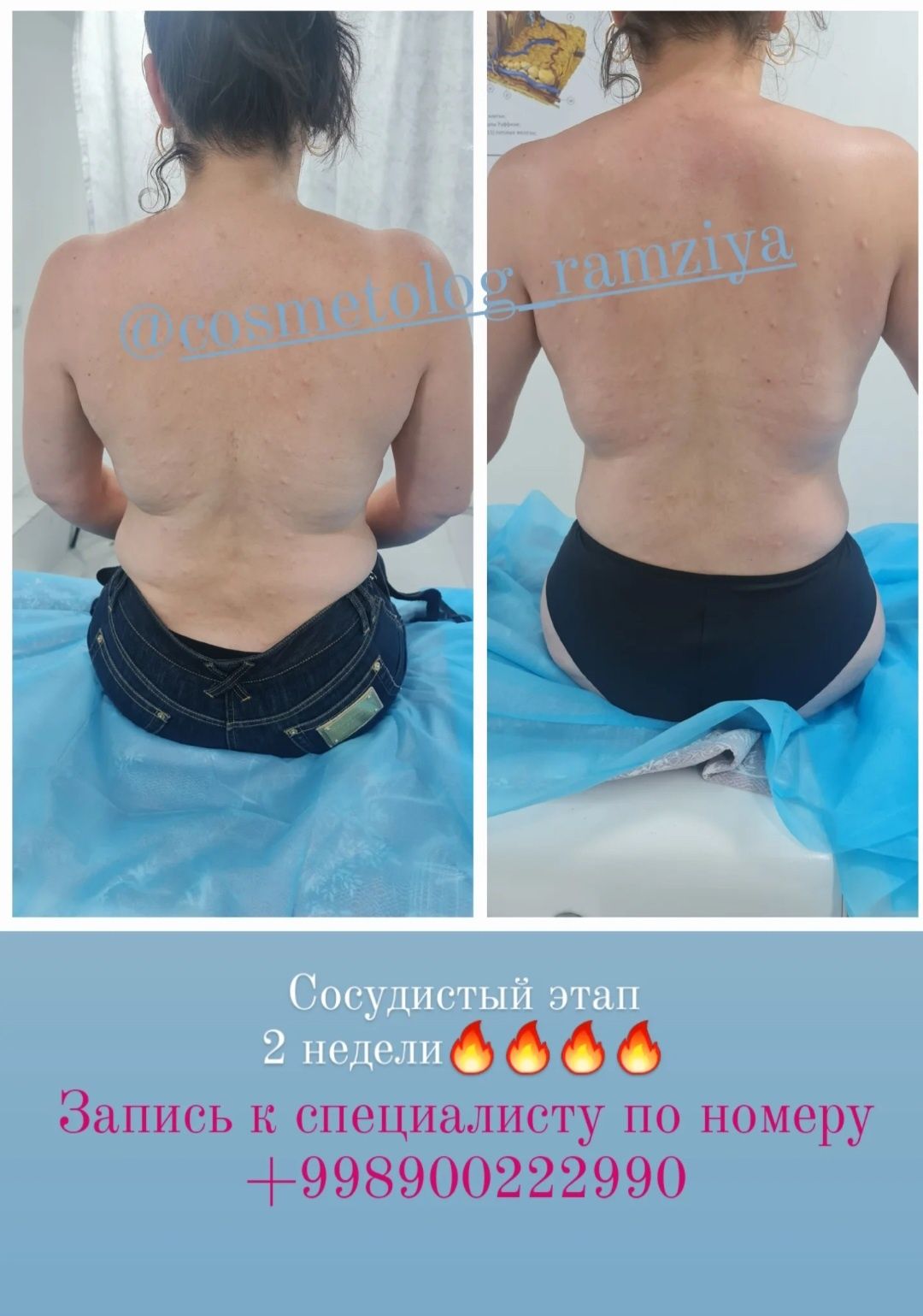 Косметологические услуги (мужчины и женщины) ,фуллфейз ботокс, губы