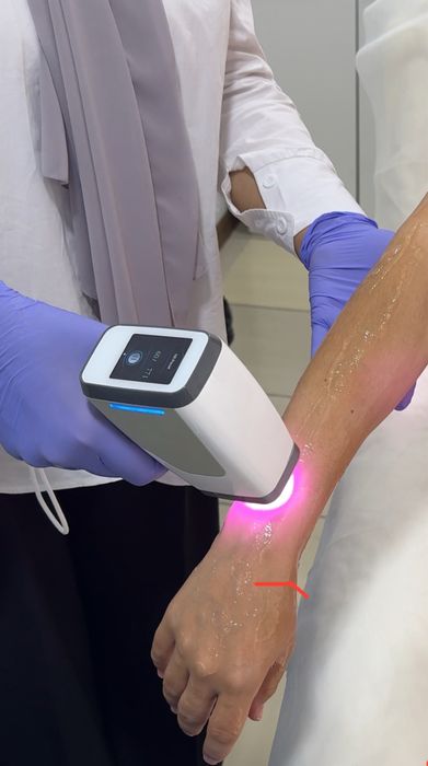 Лазерная эпиляция