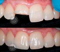 Реставрация зубы