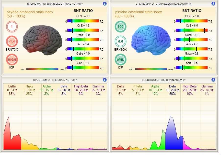HRV Biofeedback si Biofeedback/Biorezonanta SCIO