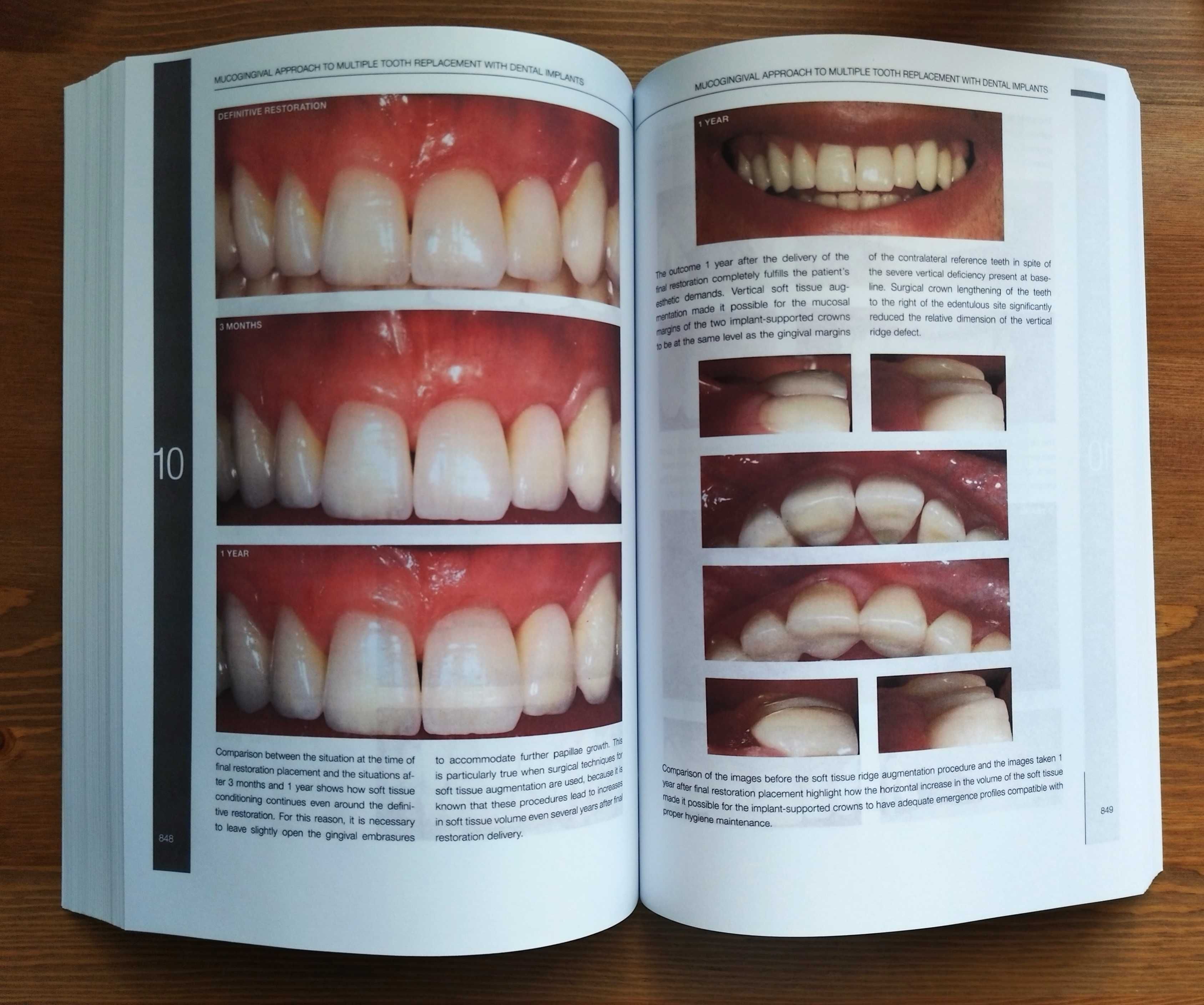 Mucogingival Esthetic Surgery around Implants/ Giovanni Zucchelli 2022