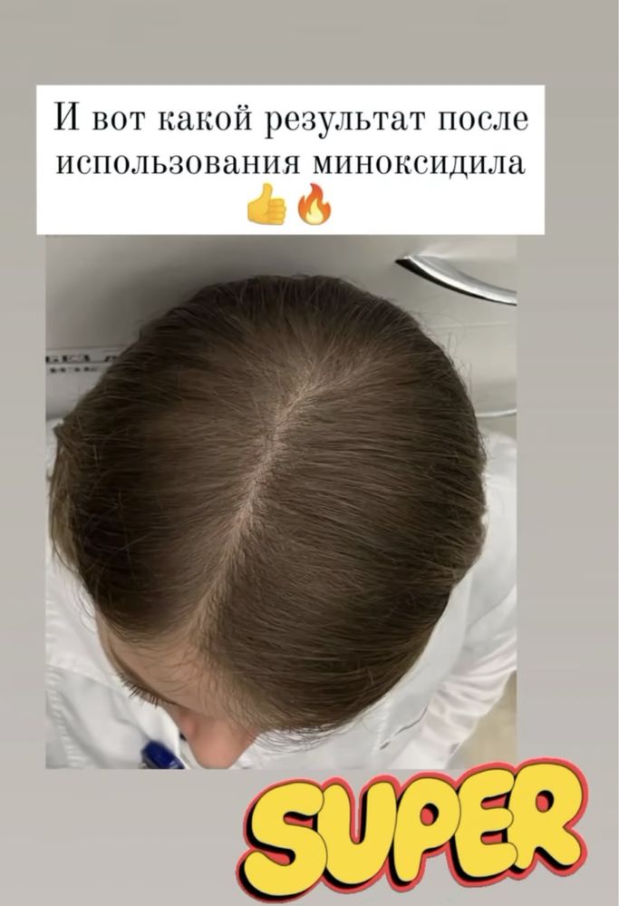 Средство для роста волос Миноксидил женский 2%