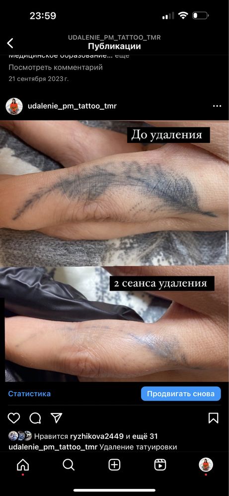 Удаление татуажа ,татуировки ,и купероза