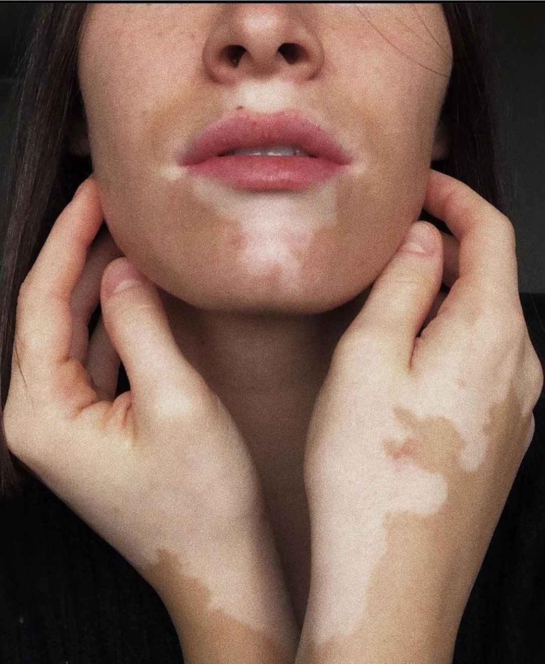 viticolor vitiligo. витиколор. Франция. БАД