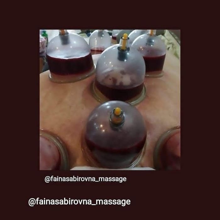 Хиджама для оздоровления и омоложения