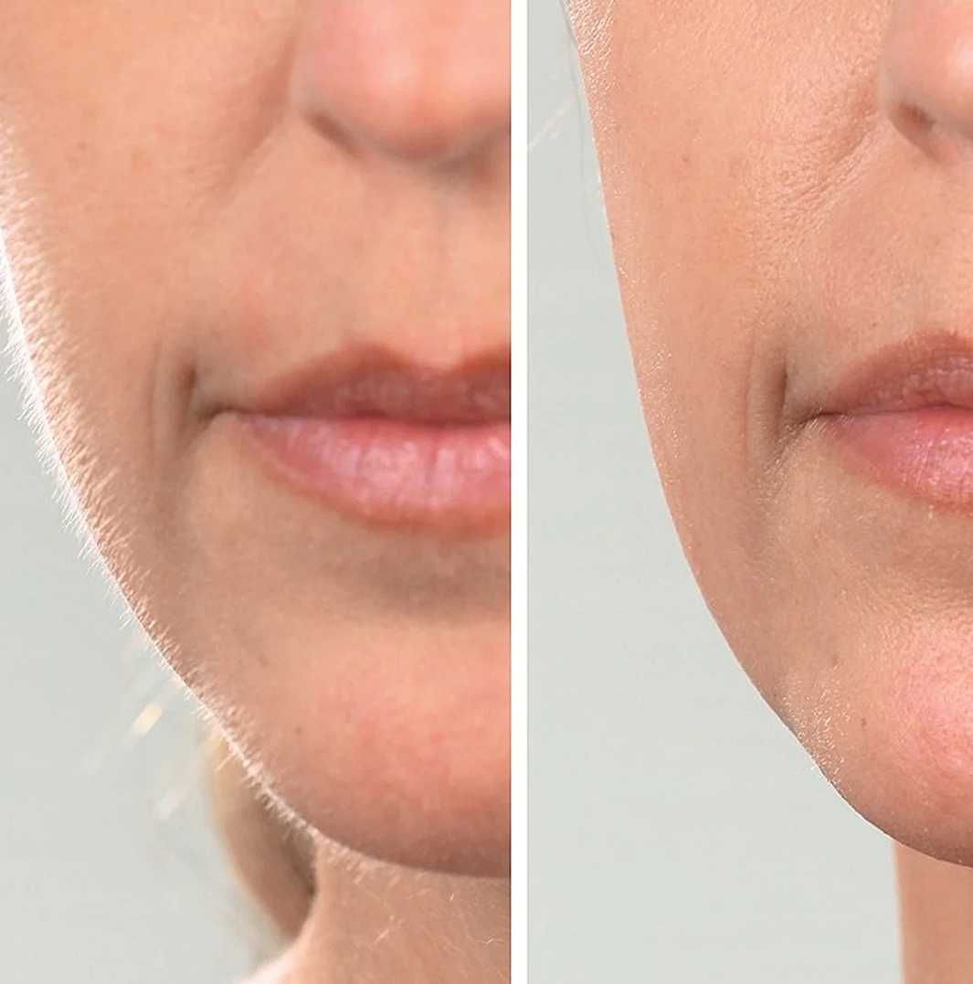Ултразвуков уред за дермапланинг DermaQueen Vibra-Sonic