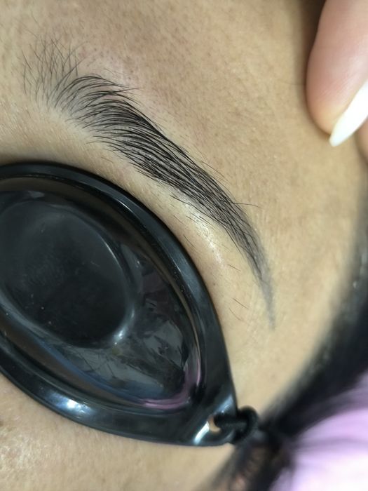 Лазерное удаление татуажа и лазерная эпиляция