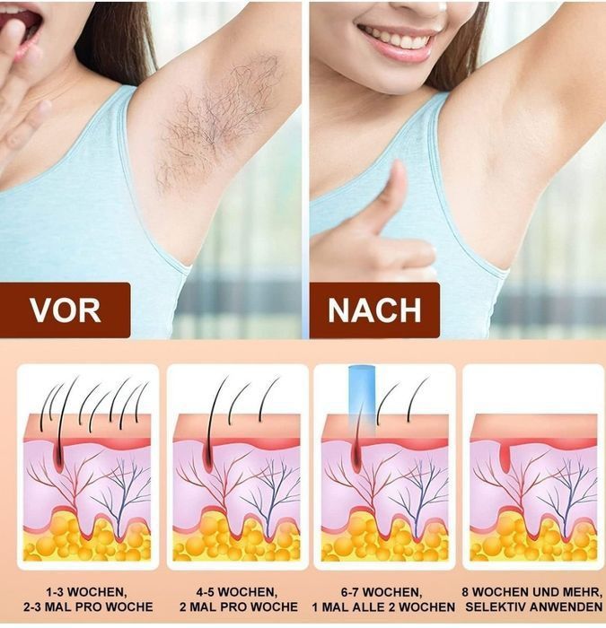 IPL Epilator laser ,dispozitiv de indepartare a parului