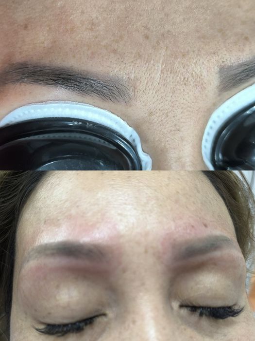 Лазерное удаление татуажа и лазерная эпиляция