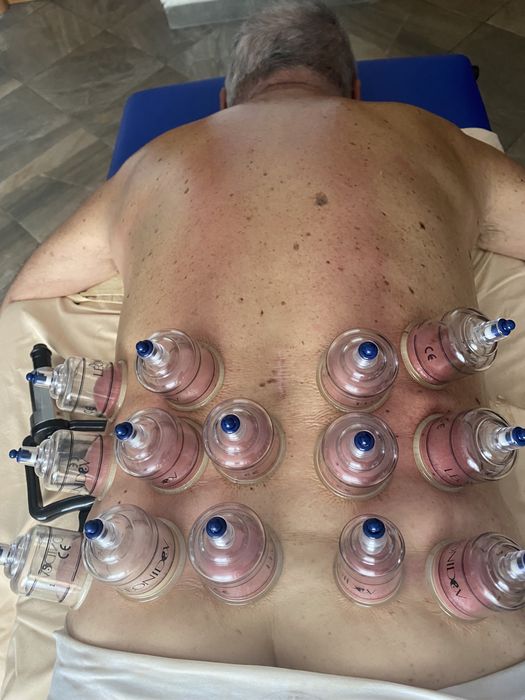 Recuperare Neurologică, Chiropractica,Acupunctură, Cupping( Ventuze)