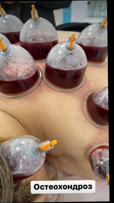 Хиджама шертпе ангина все виды делаем