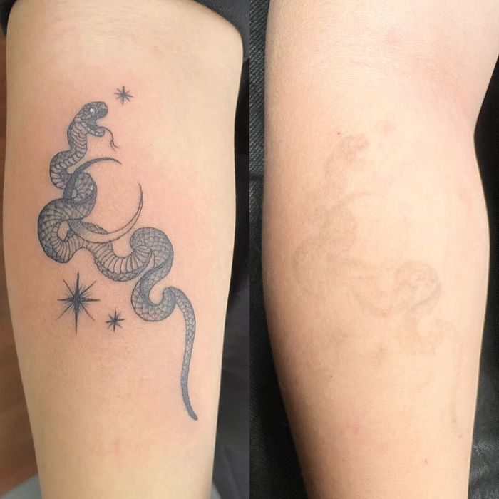 Удаление тату и татуаж