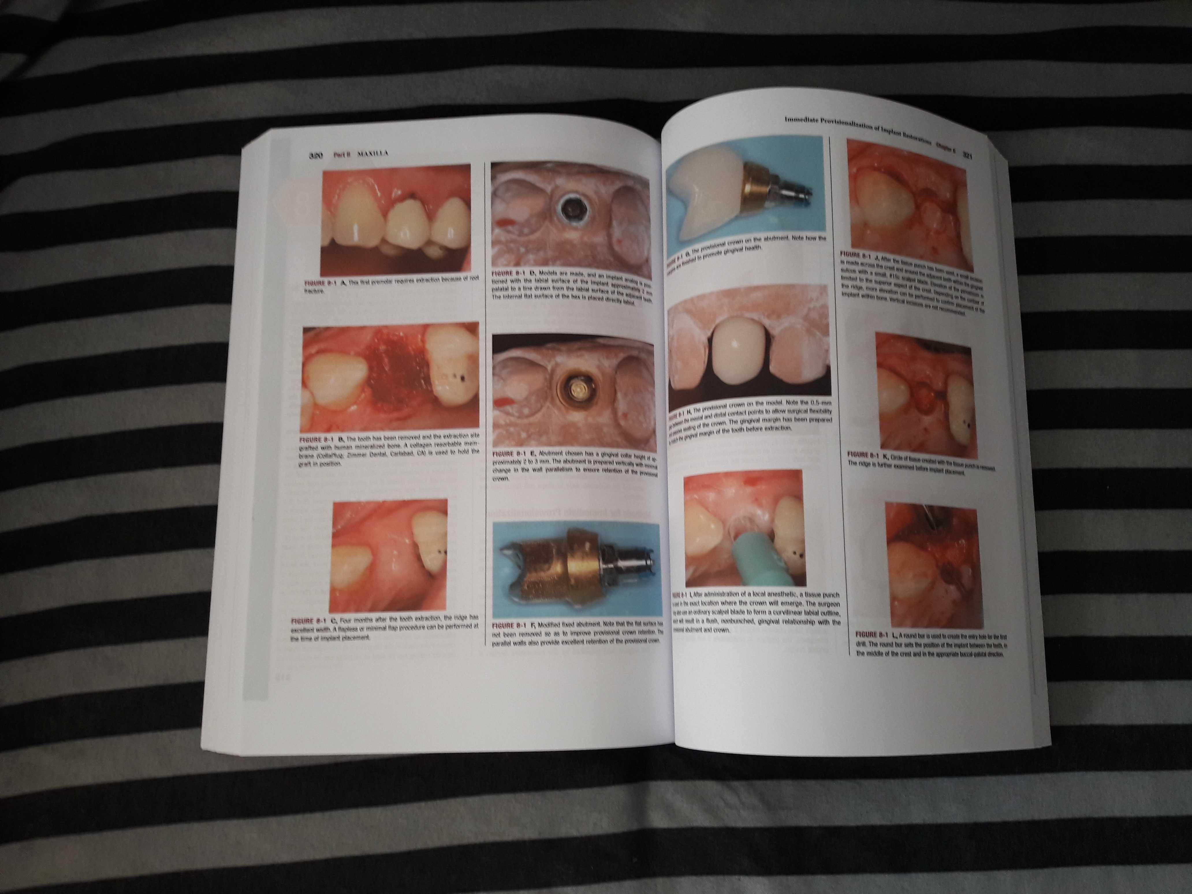 Dental Implant Complications, Stuart J. Froum Edition 2 - 2016