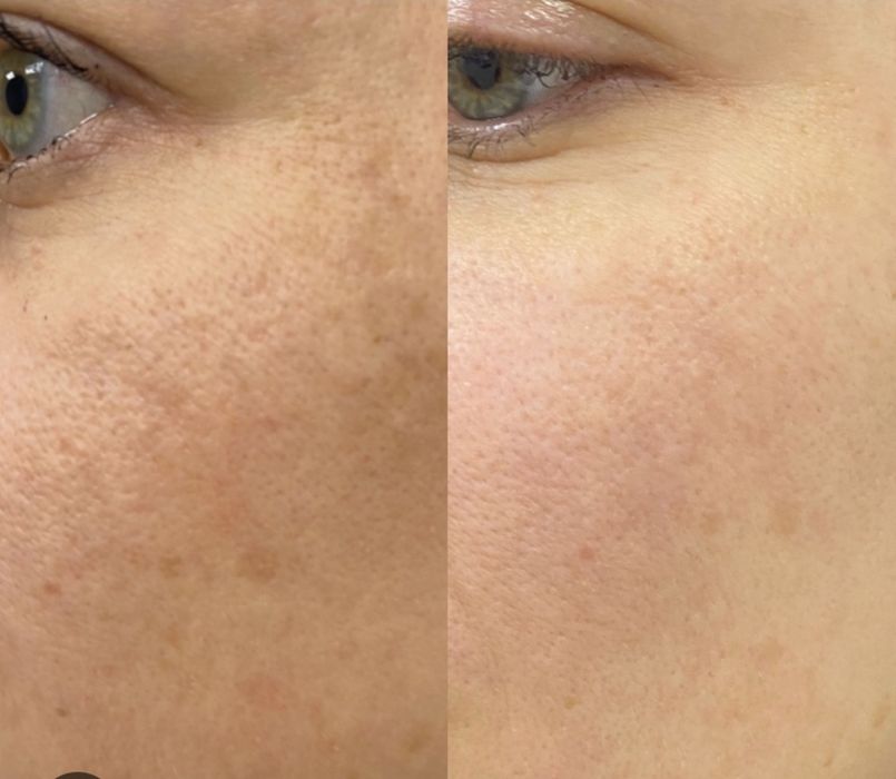 YUZDAGJ DOGLARni ketqazish, meza, biorevitalizatsiya. Отбеливание, уда