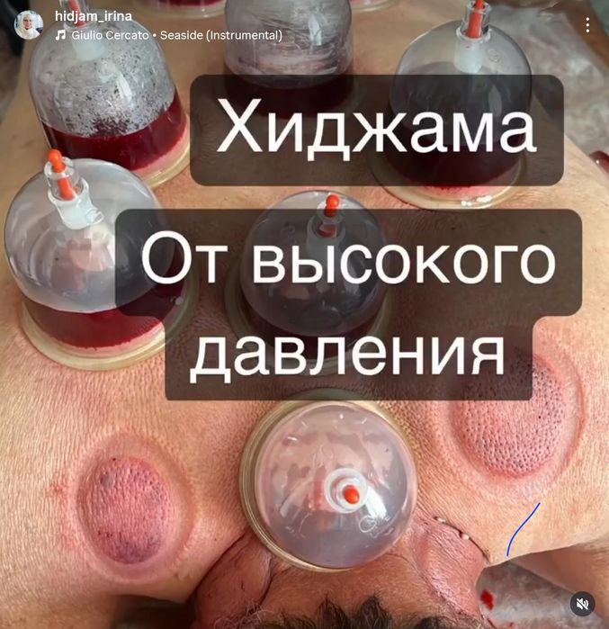 Хиджама. Стаж 30 лет.Гирудотерапия от простатита, Массаж аюрведиче