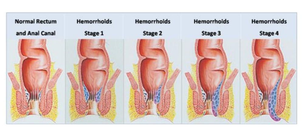 Геморой  очищени
