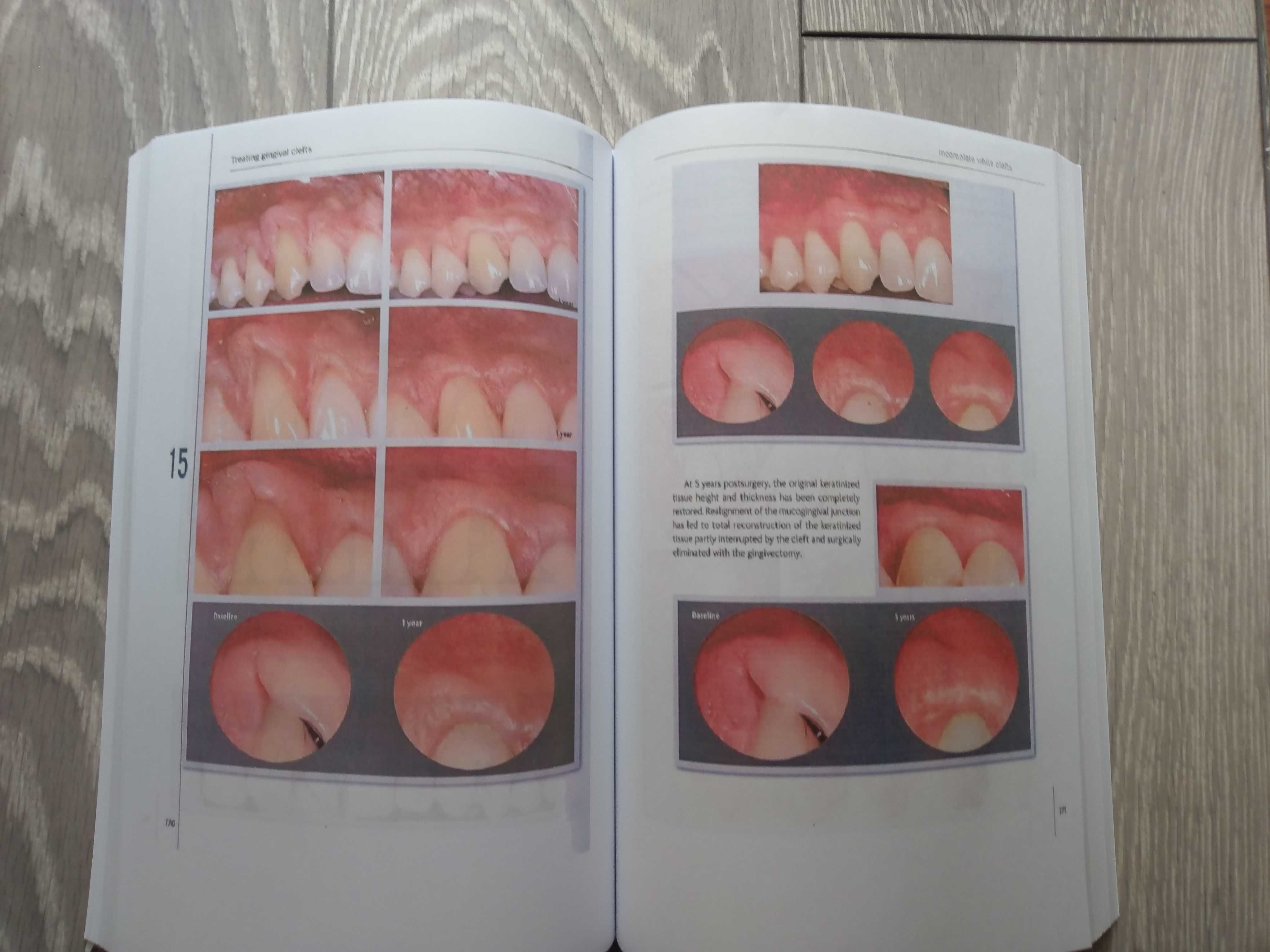 Mucogingival Esthetic Surgery - Giovanni Zucchelli - 1 Edition 2012