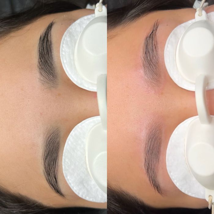 Удаление тату и татуаж