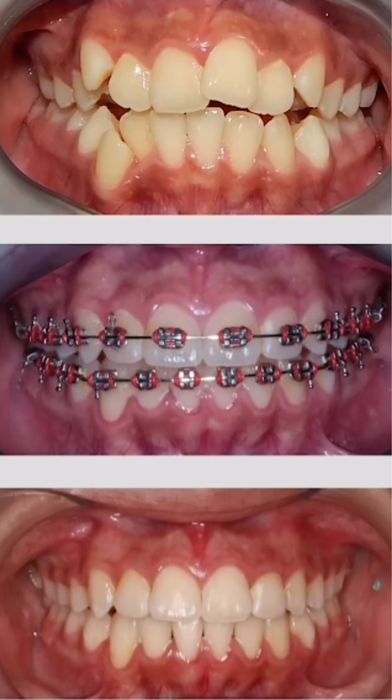 Брекет установка за 45000тг на один челюсть