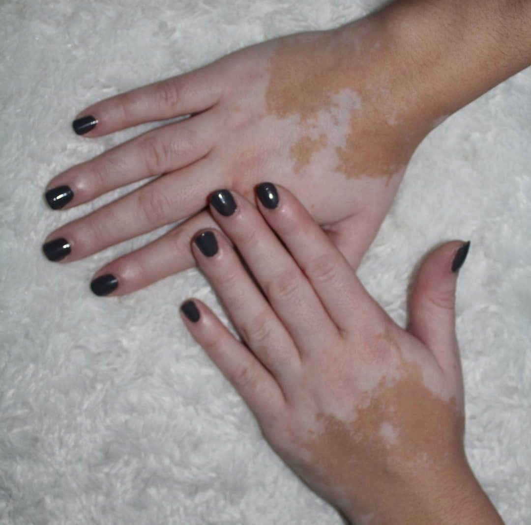 viticolor vitiligo. витиколор. Франция. БАД