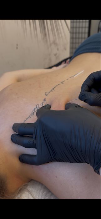 Acupunctura - Tratarea durerilor / Masaj decontracturant