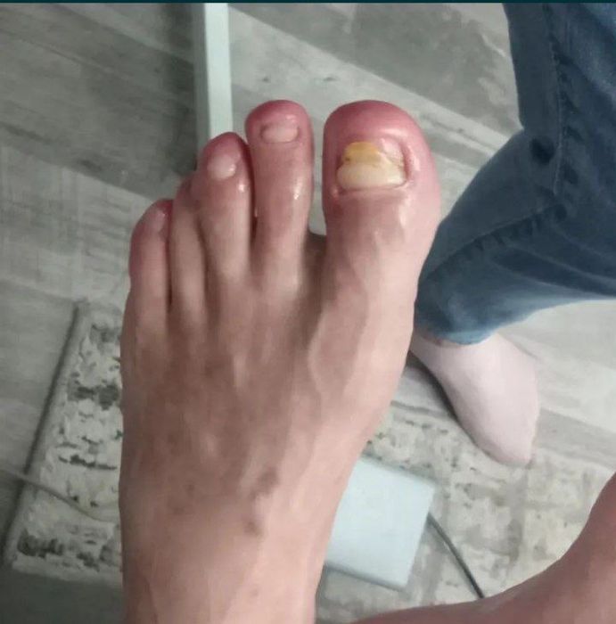 педикюр лечебный подолог на дому !