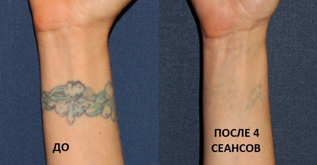 Удаление татуажа бровей губ татуировок Лазером