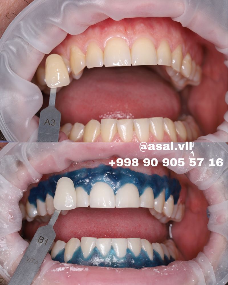 Тиш оркатириш Отбеливание системой Amazing White