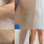 Epilare definitiva cu laser Dioda