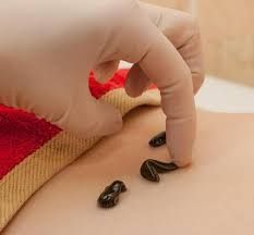 Zuluk va hijama xizmati