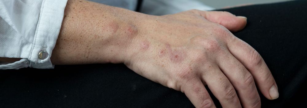 Plosnite de pat plosnita de apartament dezinsecție