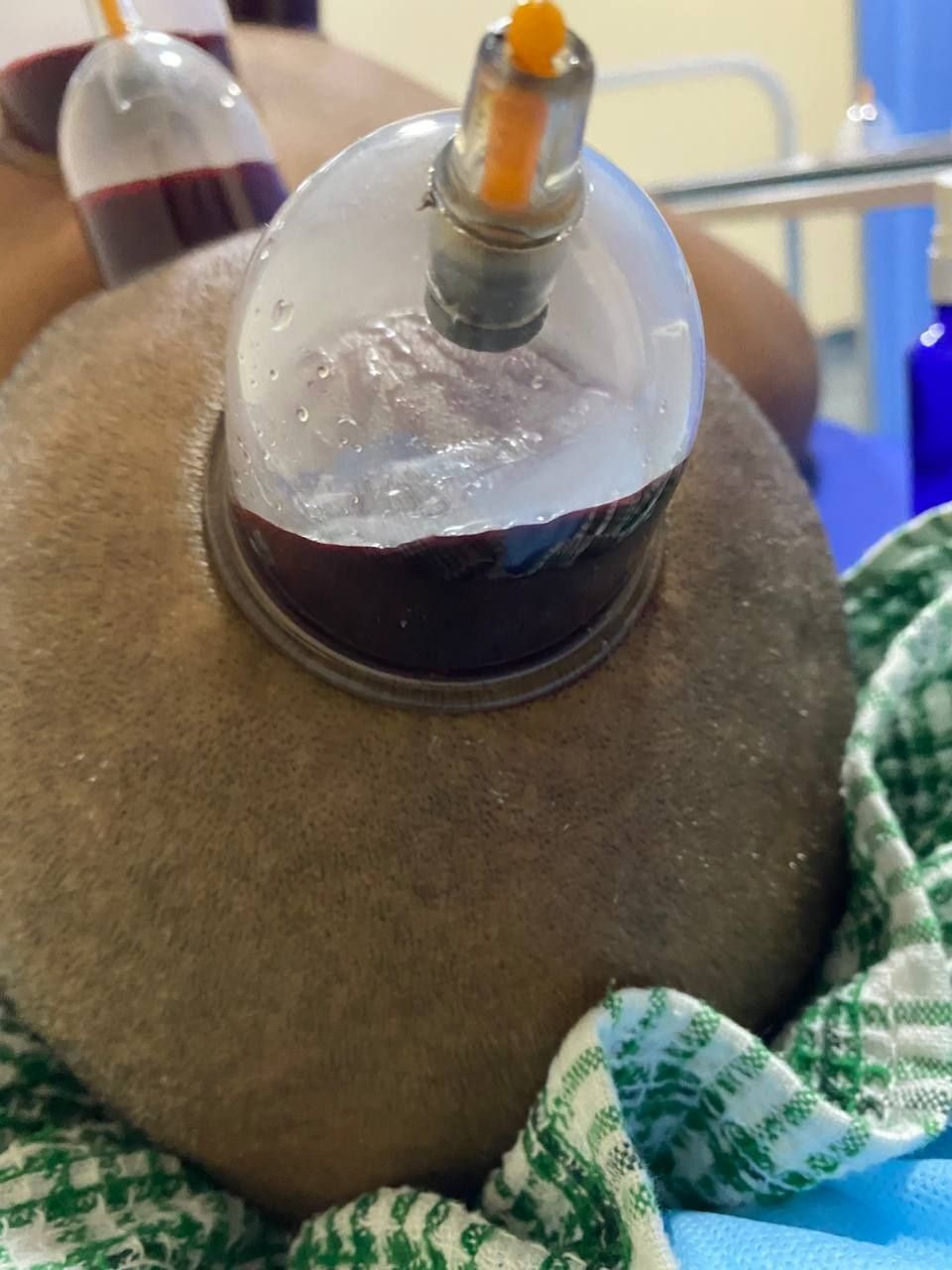 Hijama тек Индивидуальный банкалармен